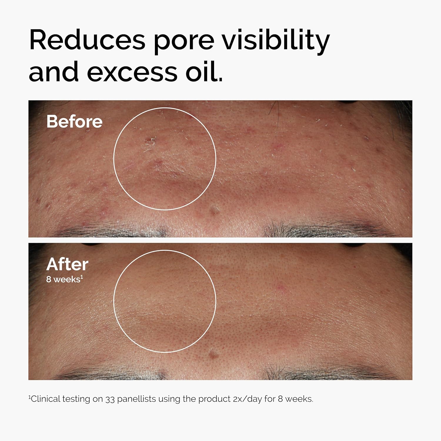 1% zinc pca for sebum regulation and oil control