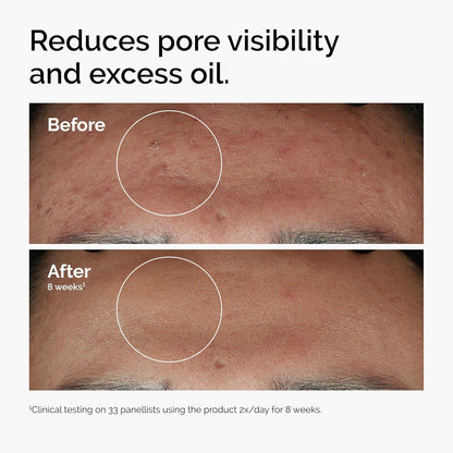 1% zinc pca for sebum regulation and oil control