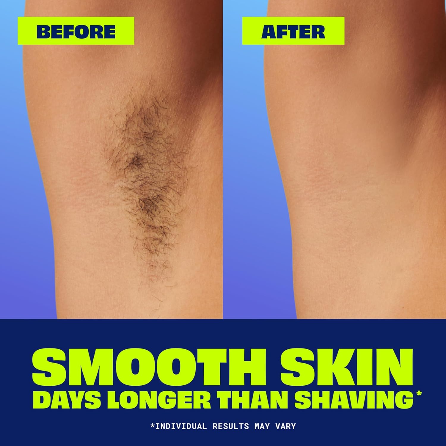 depilatory action that dissolves hair below the skin's surface