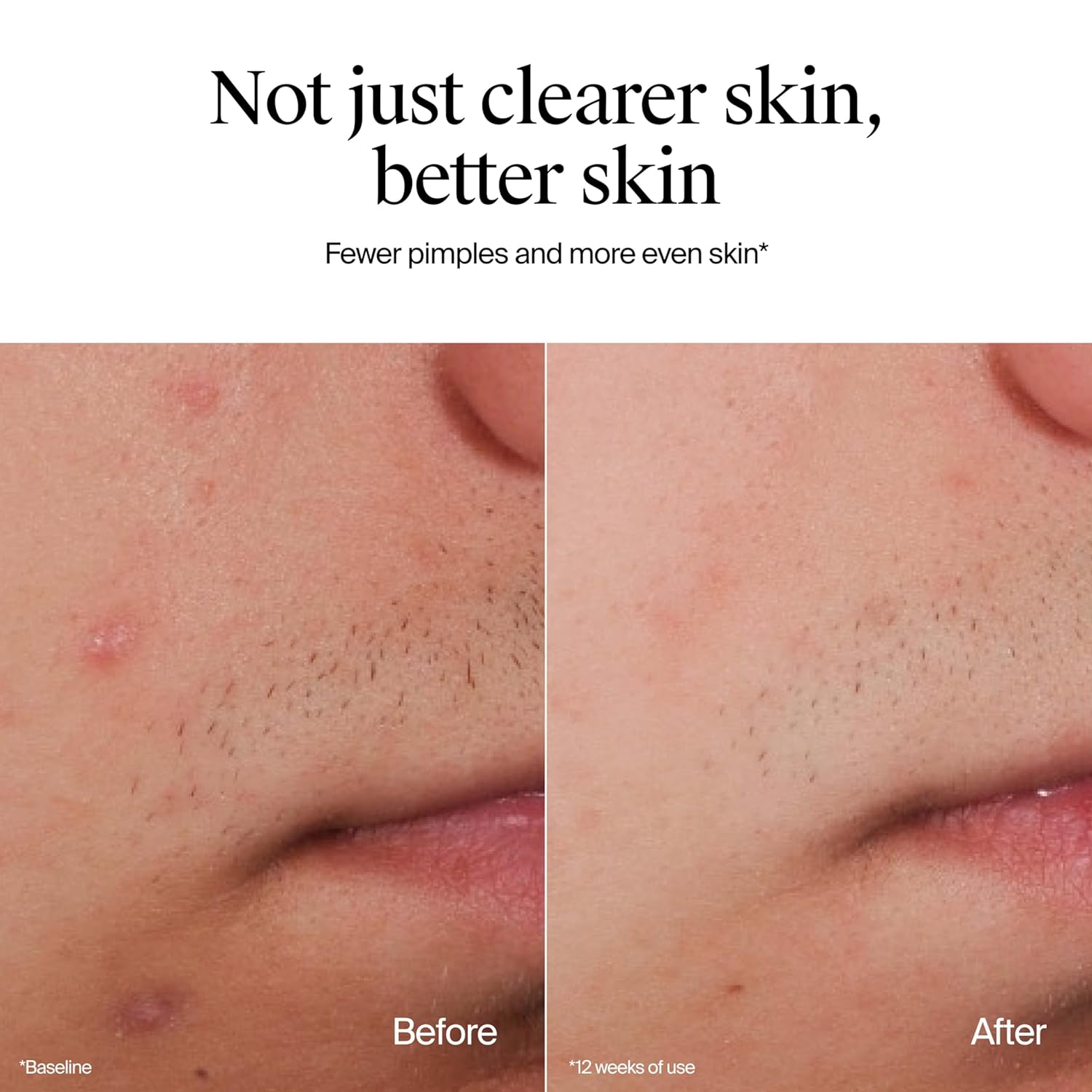 dermatologist tested and approved for acne-prone skin