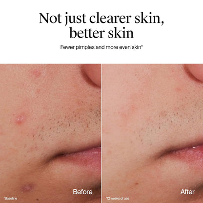 dermatologist tested and approved for acne-prone skin