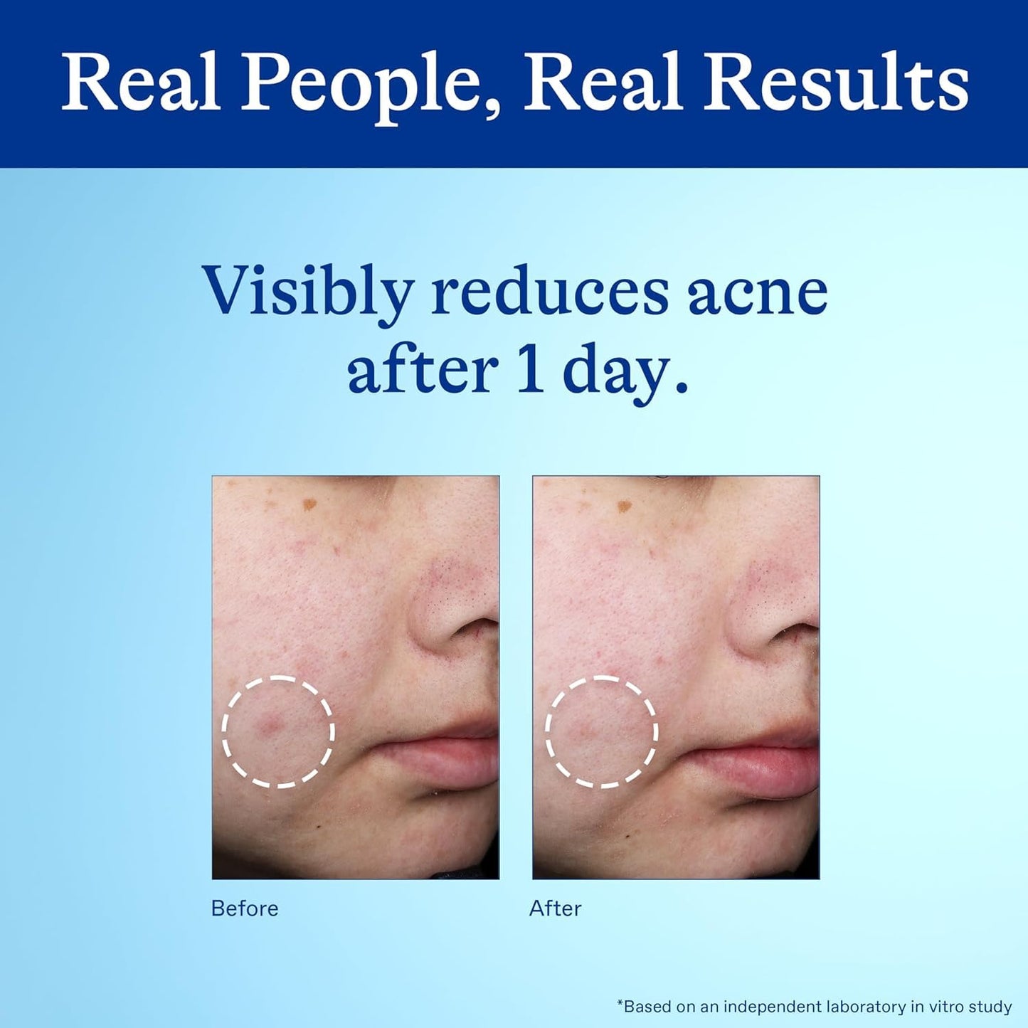 Differin 10% Benzoyl Peroxide Spot Treatment – Single-Step Targeted Blemish Care, Streamlined 1 oz Tube