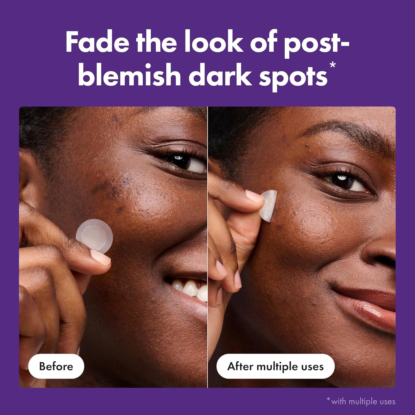 Hero Cosmetics Mighty Patch Micropoint Hyperpigmentation Patches – Intentional Single-Step Spot Treatment, Neutral Vanity Edit