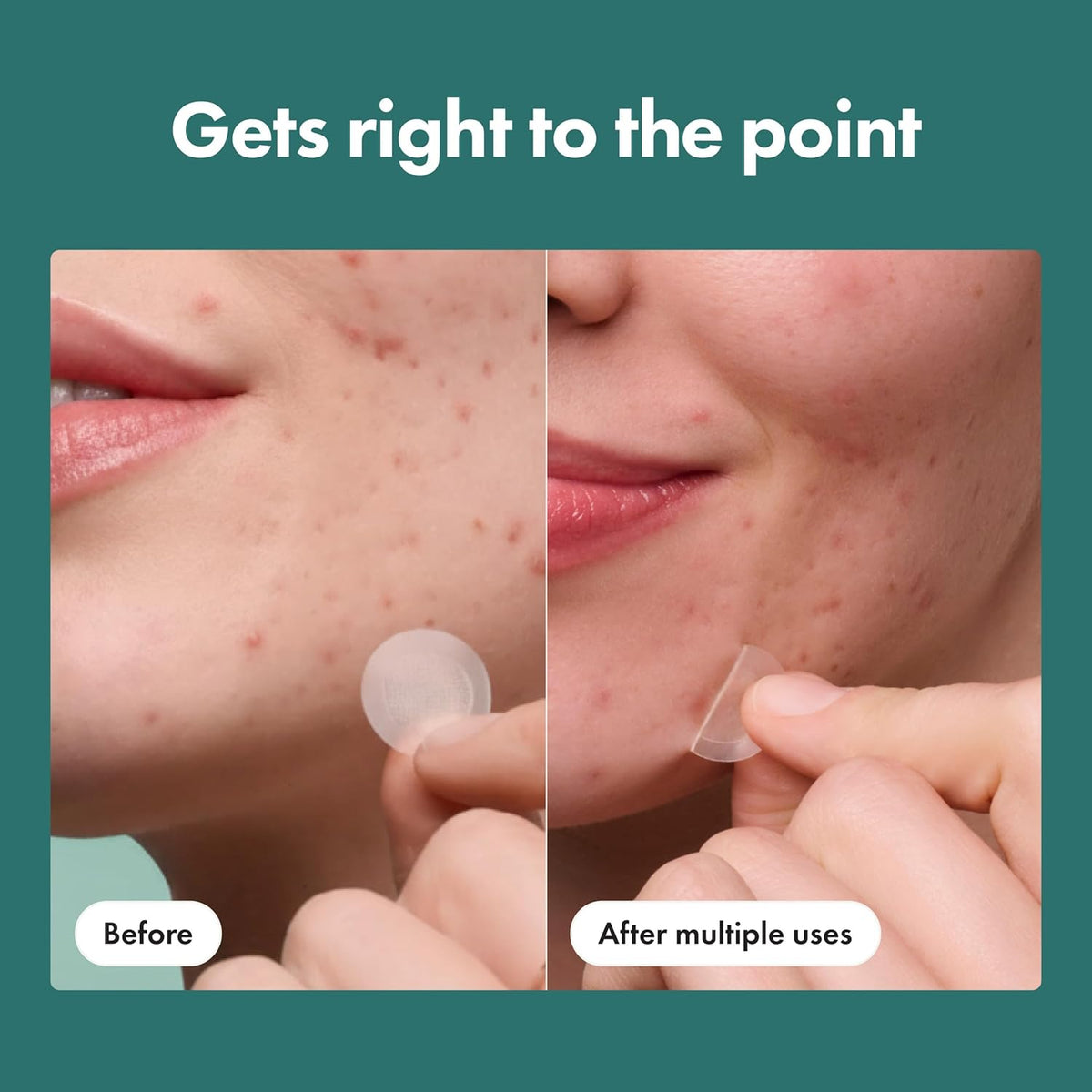 included extractor tool for hygienic blemish prep before patch application