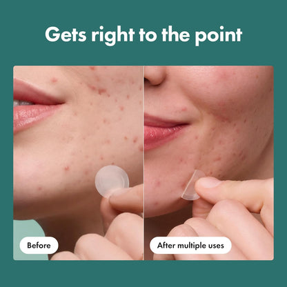 included extractor tool for hygienic blemish prep before patch application