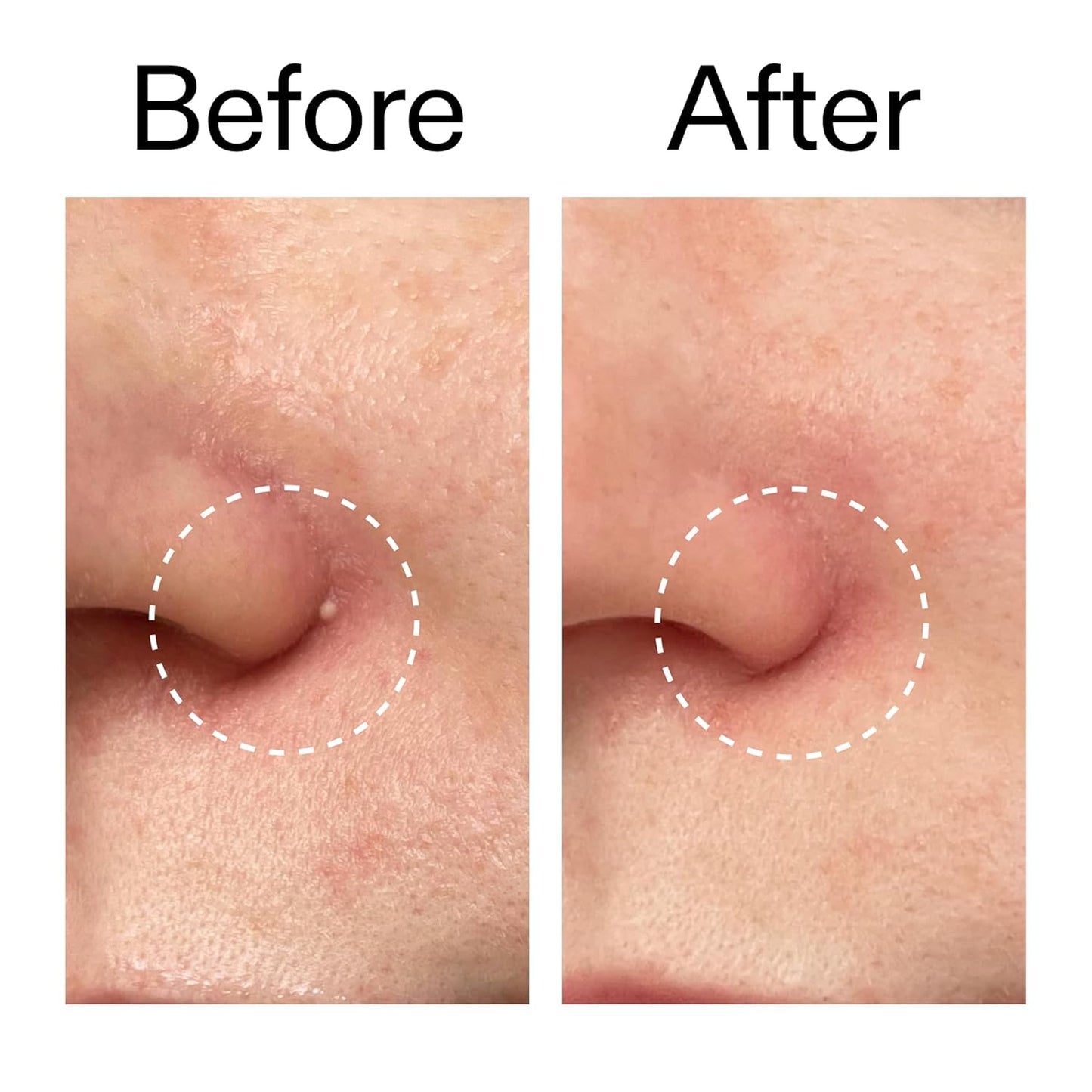 The INKEY List Hydrocolloid Invisible Pimple Patches Quick Spot Fix for Busy Work-from-Home Professionals
