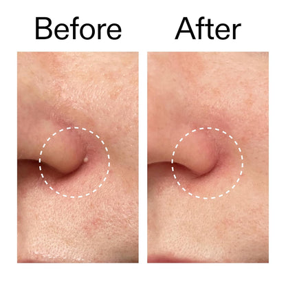 The INKEY List Hydrocolloid Invisible Pimple Patches Quick Spot Fix for Busy Work-from-Home Professionals