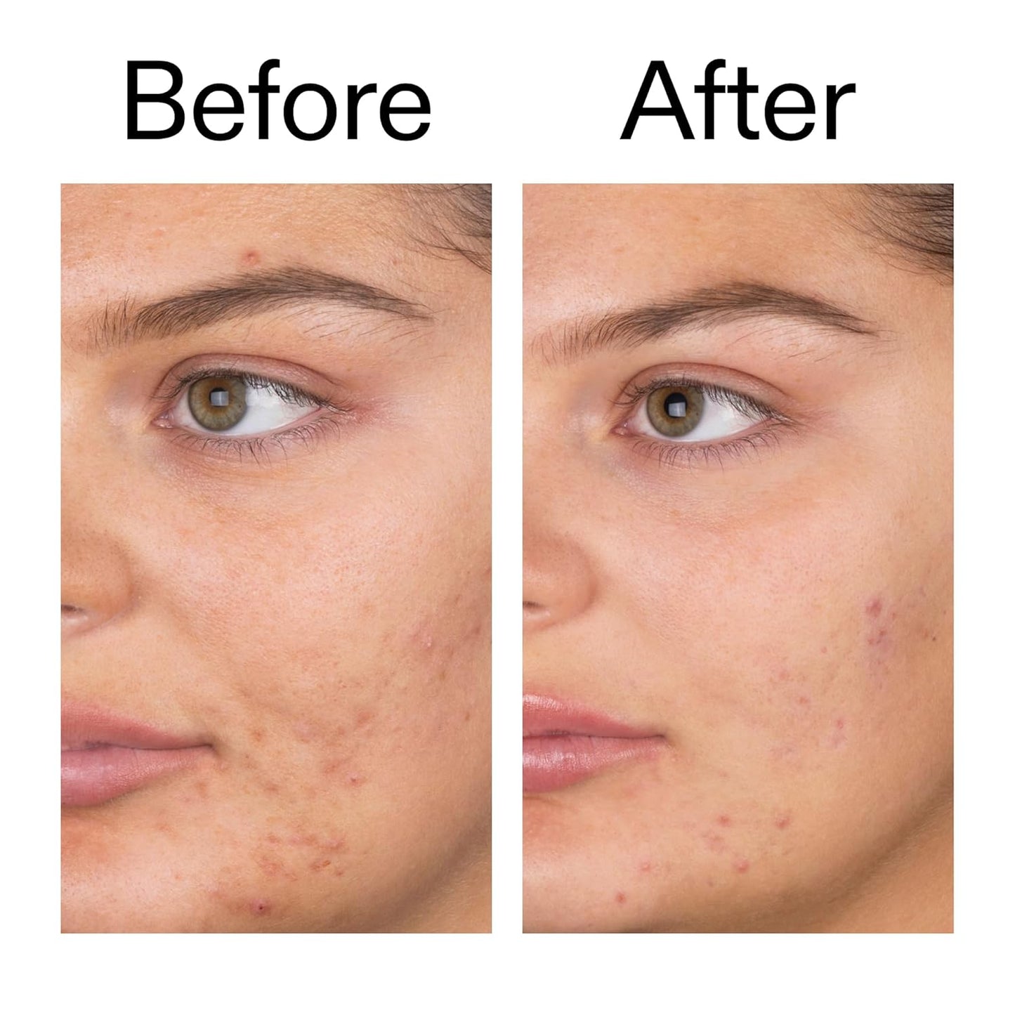 The INKEY List Salicylic Acid Cleanser - Post-Gym Wash for Sweaty, Active Lifestyles