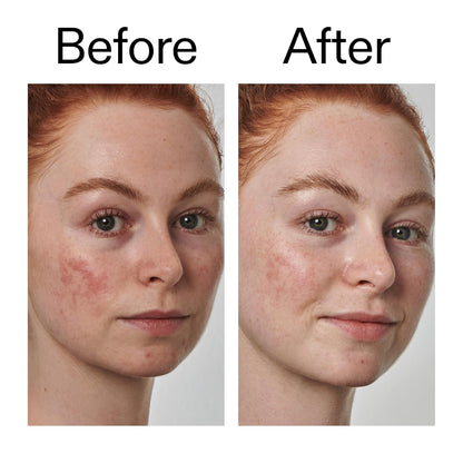 The INKEY List SuperSolutions Azelaic Acid 10% Serum – Gentle Daily Serum for Sensitive, Reactive Skin